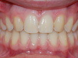 missing lateral incisors after