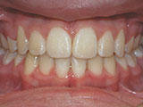 underbite after